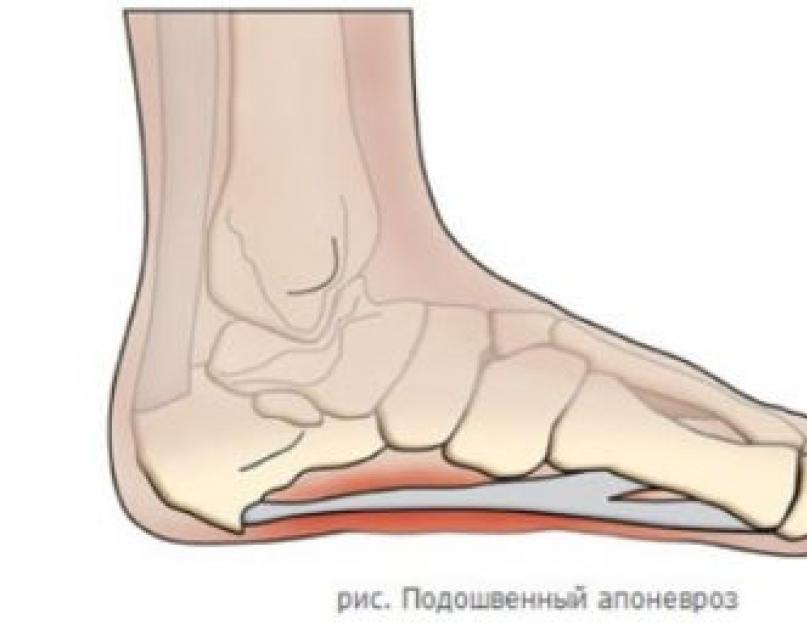 Подошвенный апоневроз. Плантарный апоневроз пятки. Подошвенный апоневроз пяточная шпора. Плантарный фасциит стопы мкб. Плантарный фасциит стопы мкб 10.